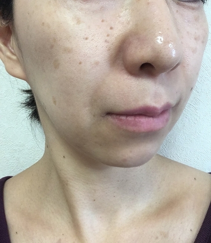 【無料】「私の肌は何タイプ！？肌質チェック」　LINE公式アカウントのご案内です