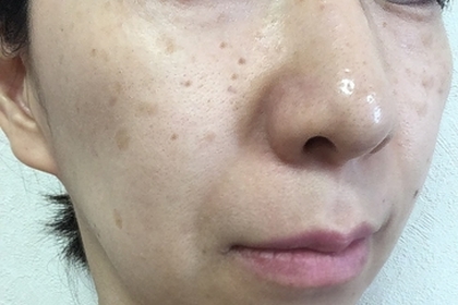 ６つの肌荒れの種類と症状